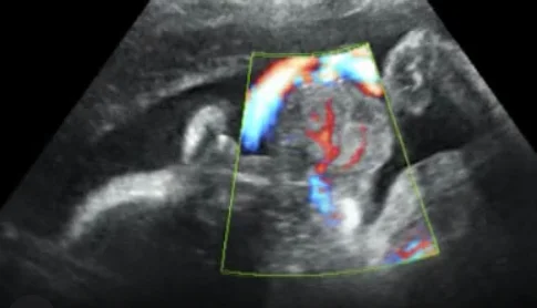U lợi bẩm sinh (Congenital Epulis / Gingival Granular Cell Tumor)