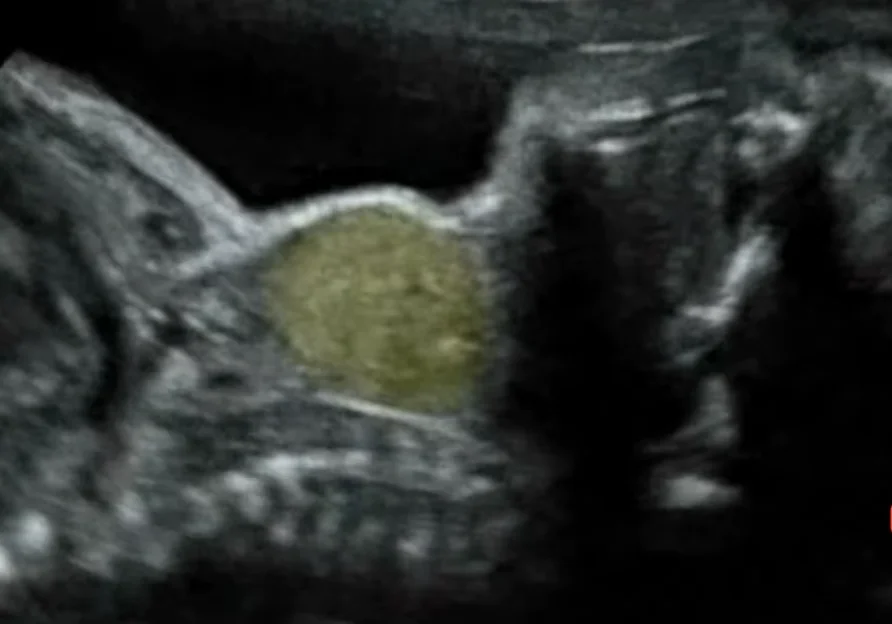 Bướu cổ thai nhi (Goiter)