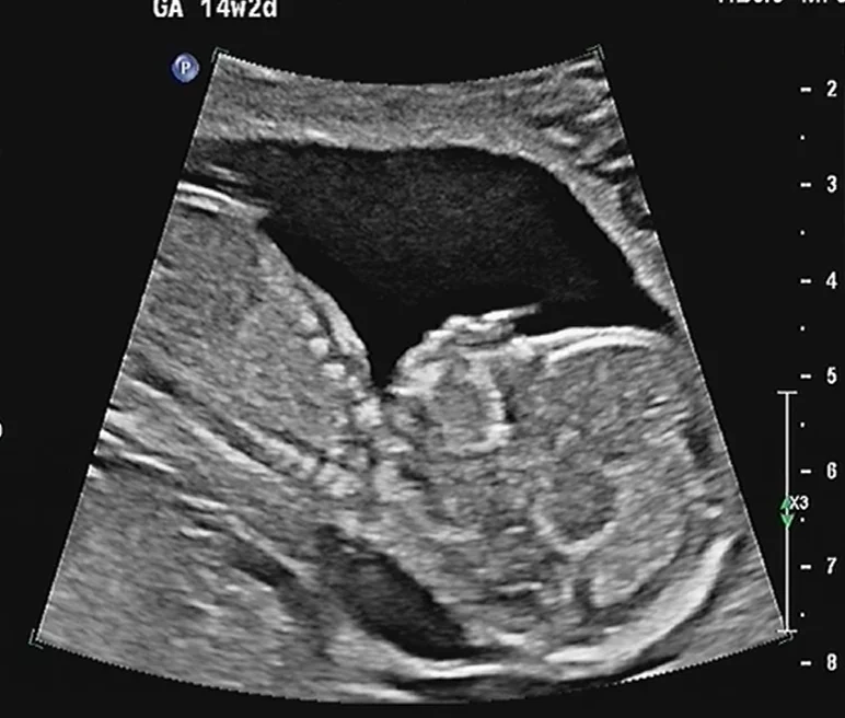 Nang bạch huyết thai nhi (Cystic hygroma)