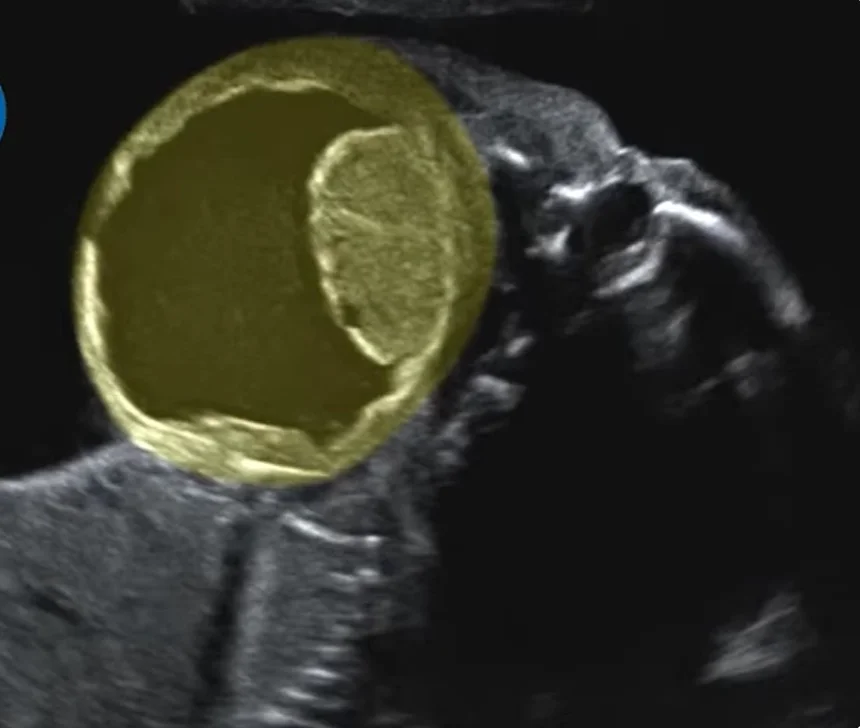 U quái vùng cổ thai nhi (Cervical Teratoma)