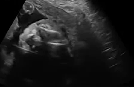 Hội chứng Wolf-Hirschhorn thai nhi (Wolf-Hirschhorn Syndrome) - đầu mặt