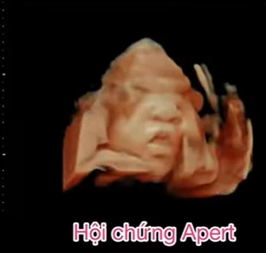 Hội chứng Apert (Apert Syndrome) - vùng đầu mặt