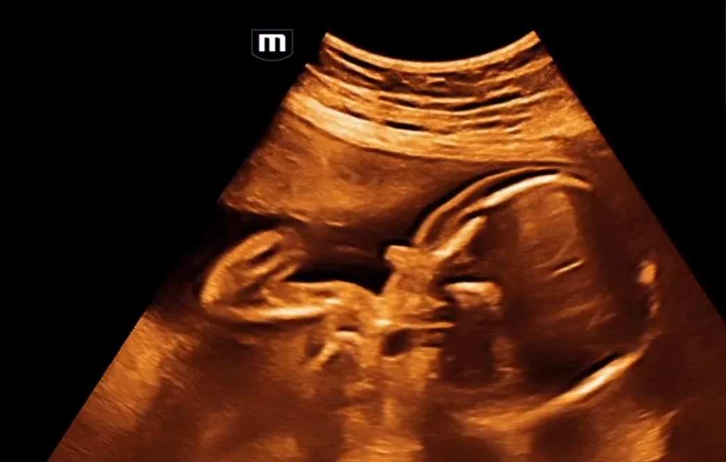 Hội chứng DiGeorge (DiGeorge syndrome) - đầu mặt