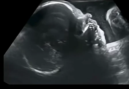 Chứng loạn sản sụn thai nhi (Achondroplasia) - đầu mặt