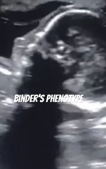 Hội chứng Binder (Binder Syndrome) / Loạn sản hàm - mũi (Maxillonasal Dysplasia)