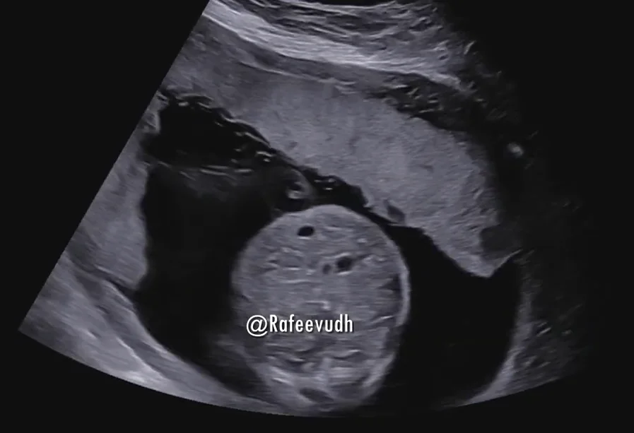 Loạn sản xương gây chết thai nhi (Thanatophoric dysplasia) - đầu mặt