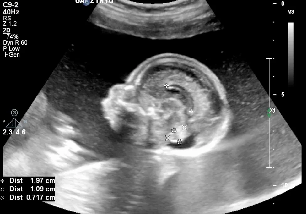 Hội chứng Treacher Collins (Treacher Collins Syndrome) - đầu mặt