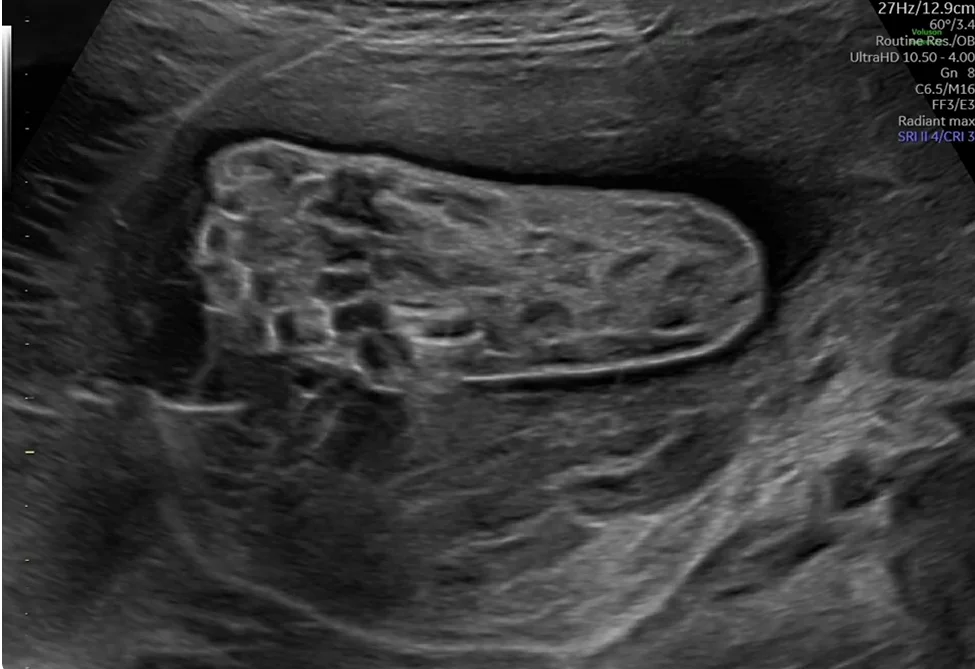 Hội chứng Goldenhar ở thai nhi (Goldenhar syndrome / Phổ OAV - Oculo-Auriculo-Vertebral Spectrum) - vùng đầu mặt
