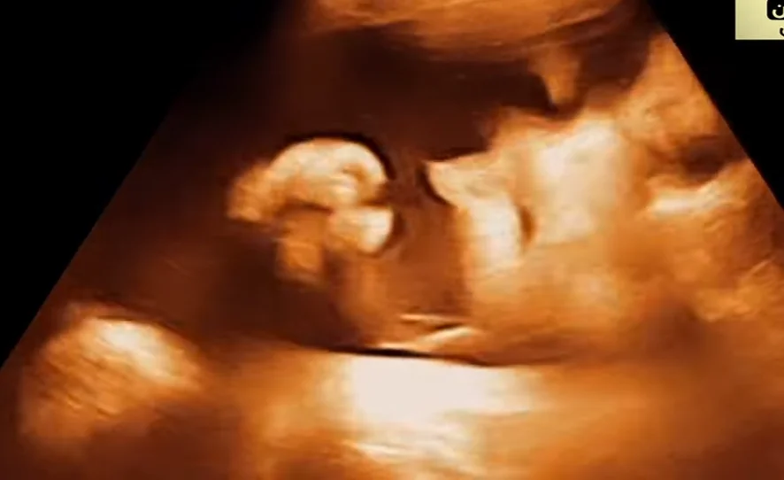 Hội chứng Beckwith-Wiedemann vùng đầu mặt (BWS)