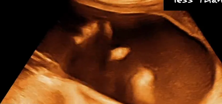 Tai đóng thấp (Low-Set Ear)