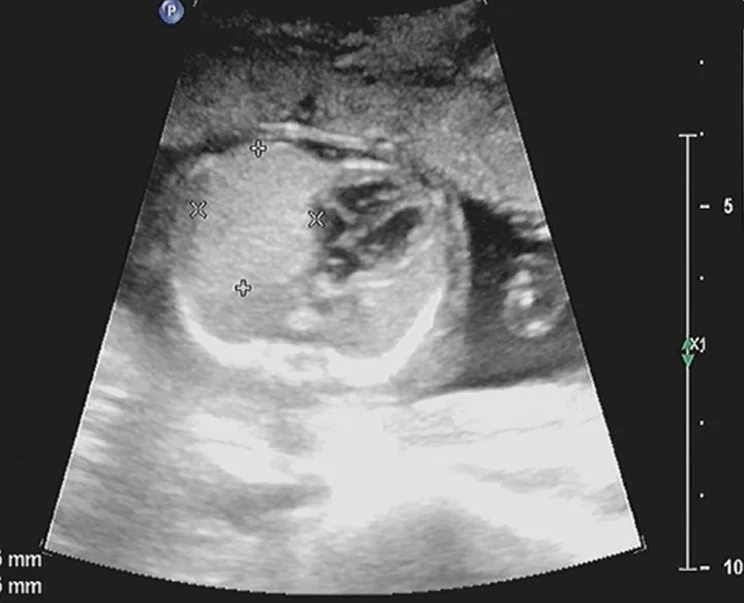 Bất thường nang tuyến phổi bẩm sinh thai nhi (Congenital Pulmonary Airway Malformation)