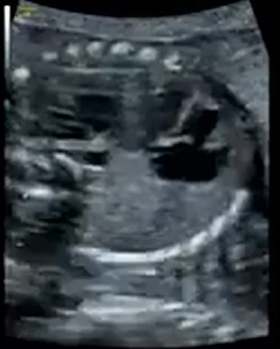 Phổi biệt trí thai nhi (Bronchopulmonary sequestration)