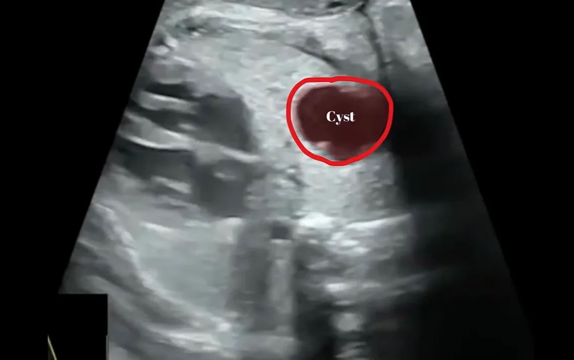 Nang phế quản thai nhi (Bronchogenic Cyst)