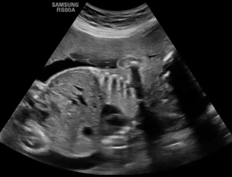 Ứ khí thùy phổi bẩm sinh (Congenital lobar overinflation)