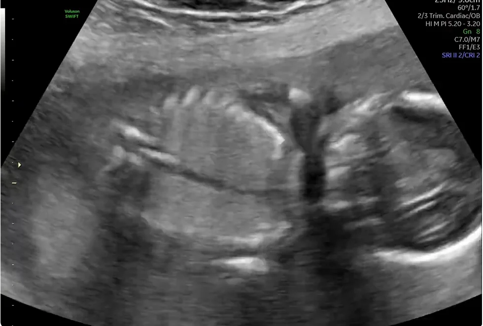 Tắc nghẽn đường hô hấp trên bẩm sinh (Congenital High Airway Obstruction Sequence) (CHAOS)