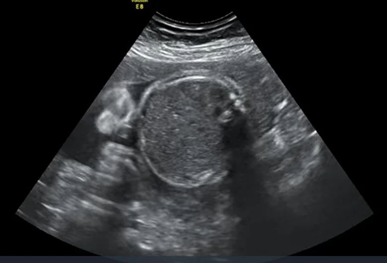 Bất sản phổi thai nhi (Pulmonary agenesis)