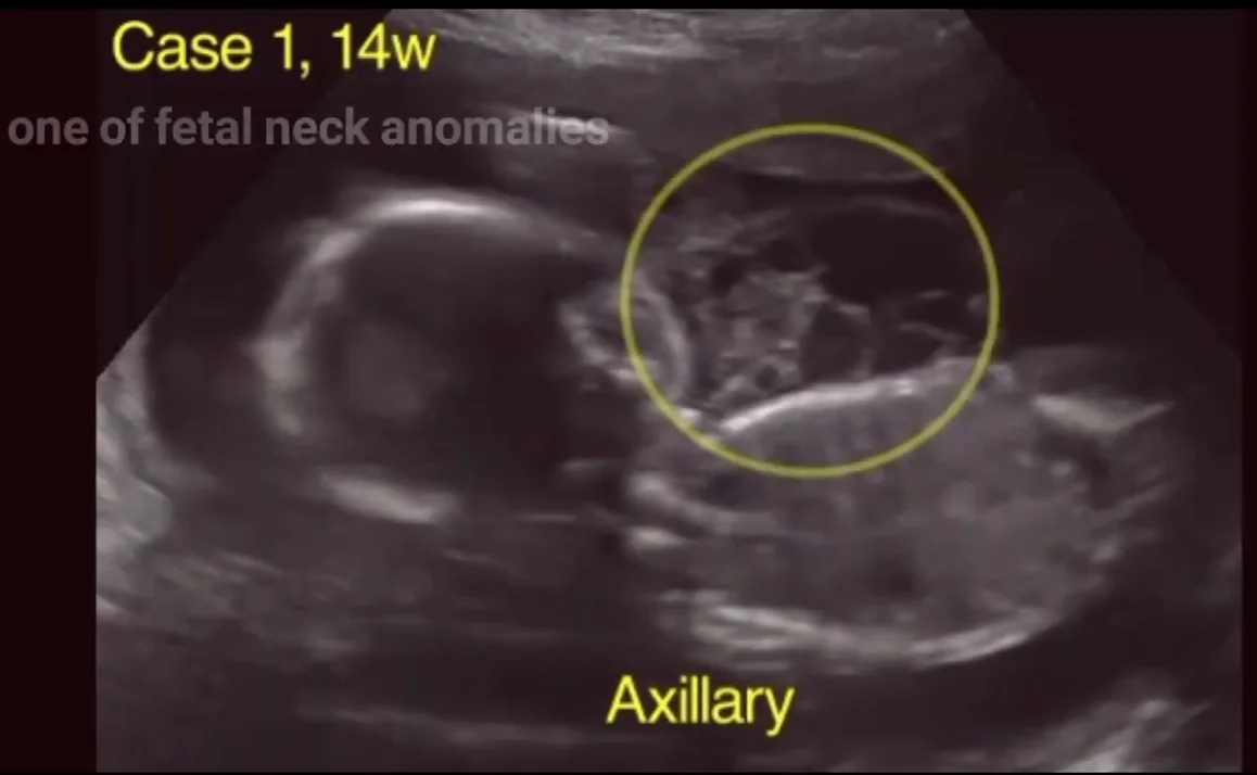 U, dị dạng bạch huyết vùng nách thai nhi (Lymphangioma)