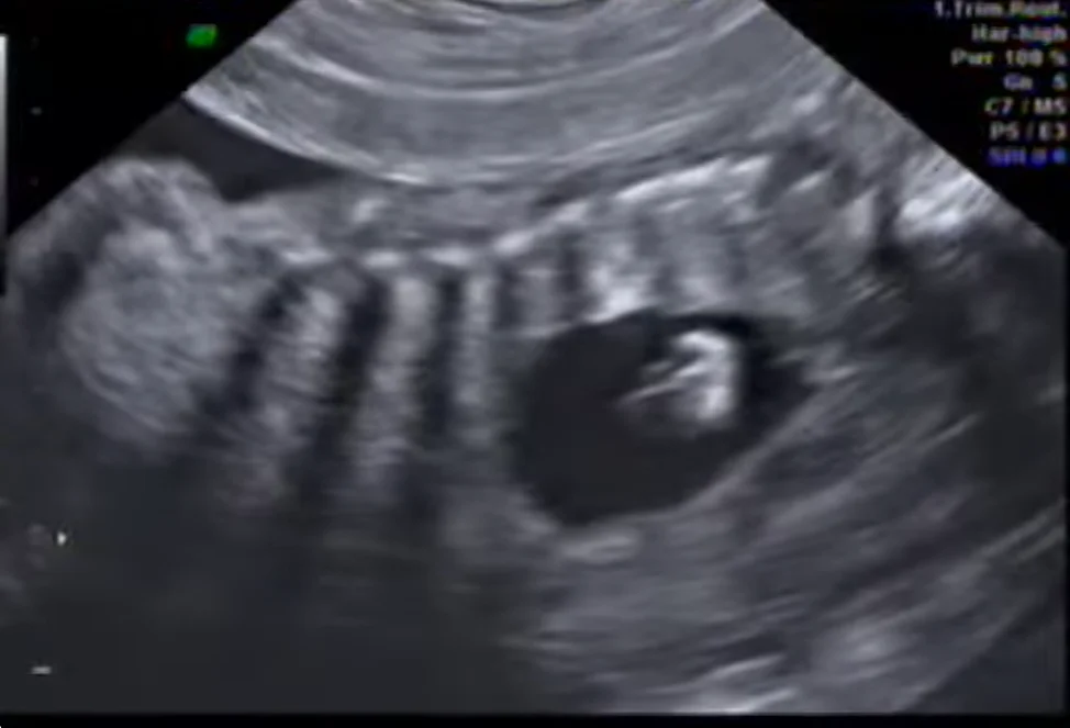 U quái trung thất thai nhi (Mediastinal Teratoma)