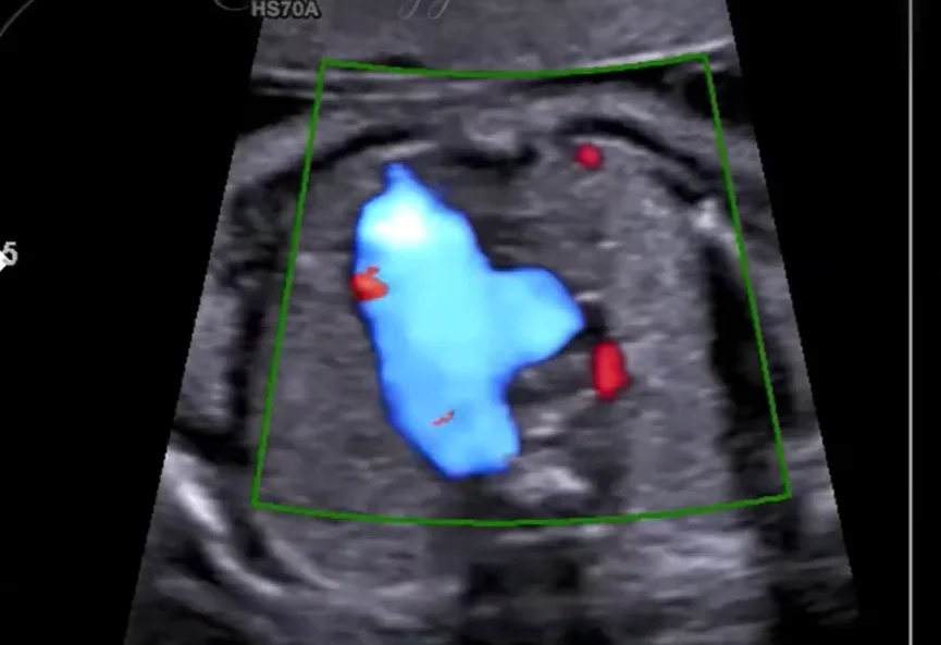 Tuyến ức bình thường thai nhi (Thymus)