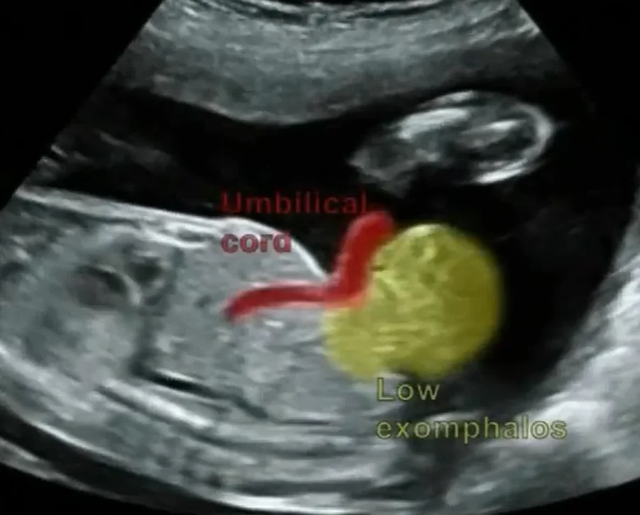 Lộn bàng quang thai nhi (Bladder Exstrophy - BE)