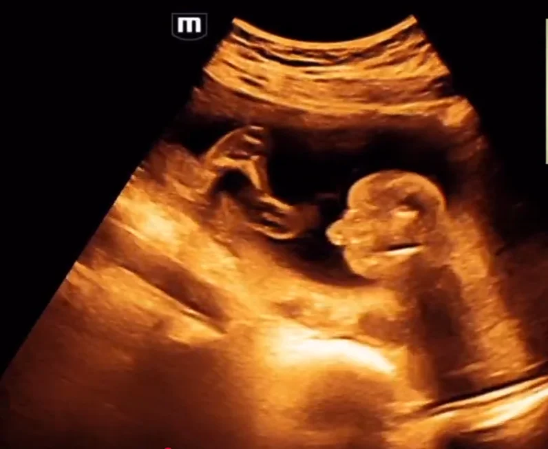 Cứng đa khớp bẩm sinh (Arthrogryposis Multiplex Congenita - AMC) / Chuỗi biến dạng do thai nhi bất động/giảm động (Fetal Akinesia/Hypokinesia Deformation Sequence - FA(H)DS)