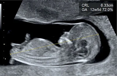 Siêu âm thai quý I bình thường