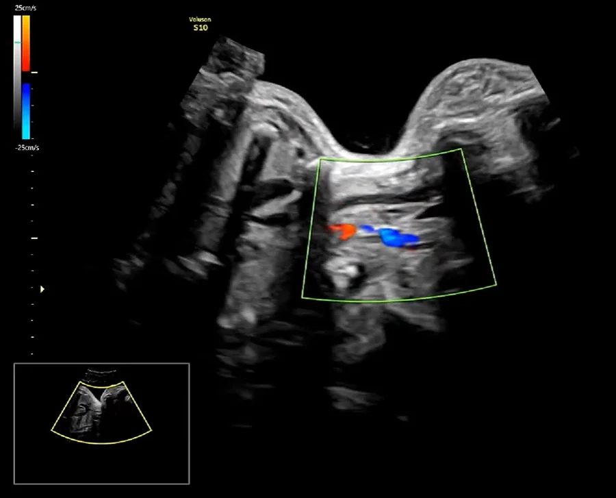 Teo thực quản thai nhi (Esophageal Atresia- EA)