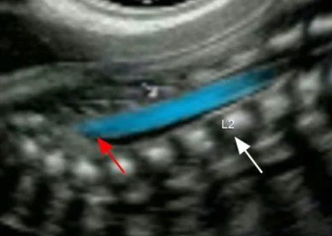 Hội chứng tủy sống bị dính (Tethered Cord )