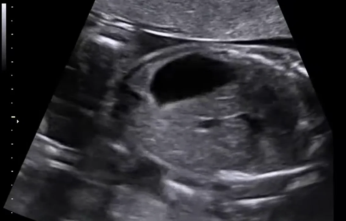 Teo tá tràng thai nhi (Duodenal atresia)