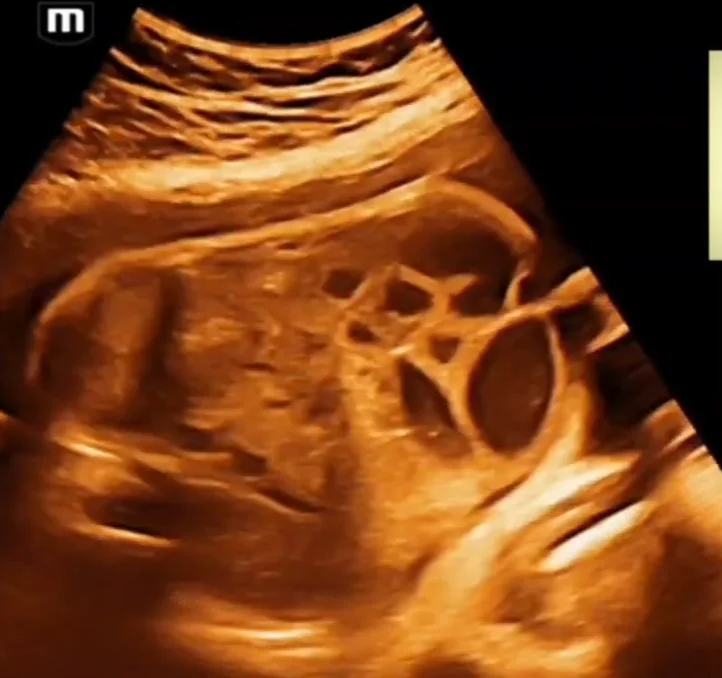 Teo hỗng - hồi tràng thai nhi (Jejunal, Ileal Atresia)