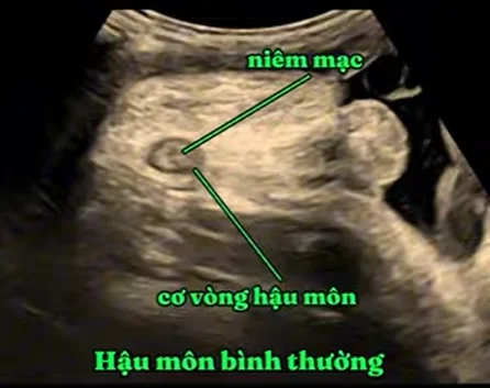 Teo đại tràng thai nhi (Colonic Atresia)