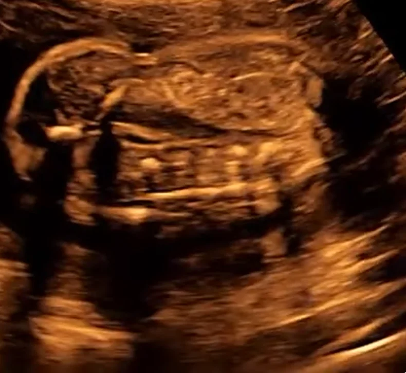 Xoắn ruột thai nhi (Volvulus)