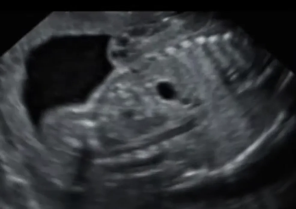 Nang ruột đôi thai nhi (Enteric Duplication Cyst)