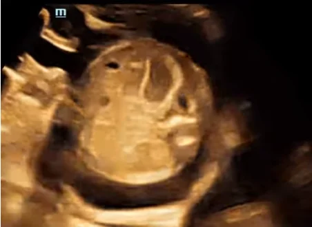 Teo / Tịt hậu môn thai nhi (Anal Atresia)