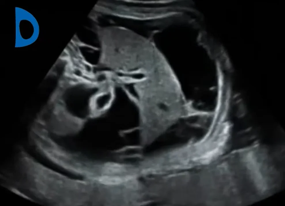 Viêm phúc mạc phân su bào thai (Meconium Peritonitis)