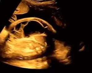 U bạch huyết mạc treo thai nhi (Mesenteric Lymphangioma)