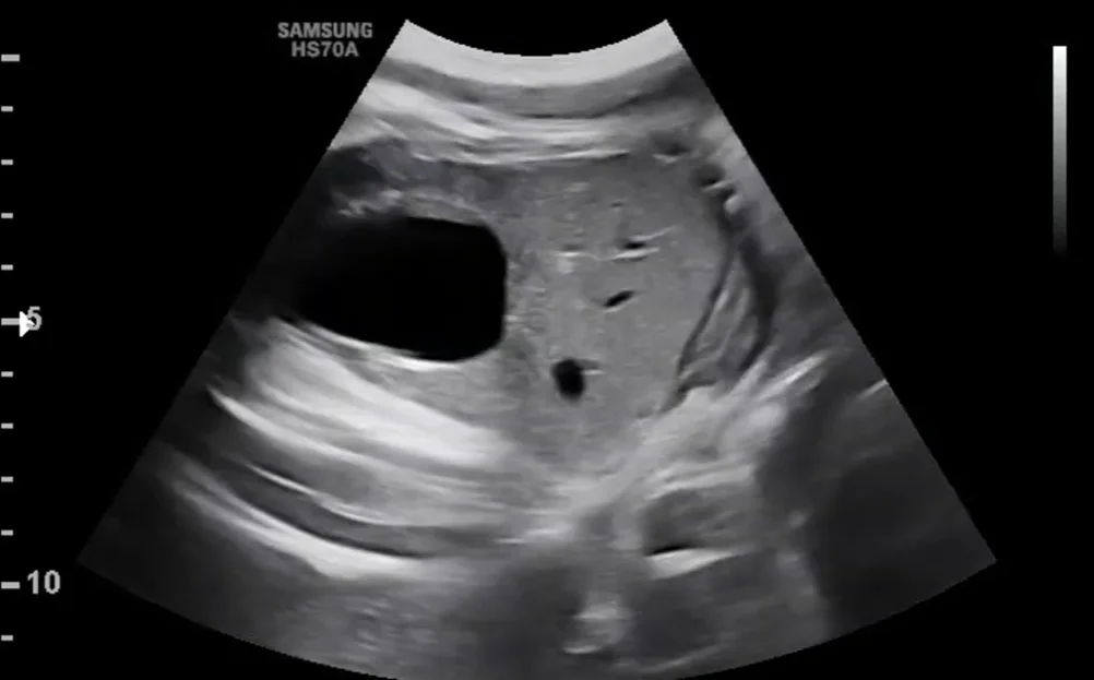 Sỏi mật thai nhi (Gallstones)