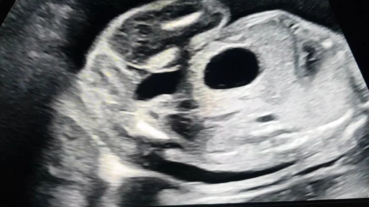 Nang ống mật chủ thai nhi (Choledochal Cyst - CC)