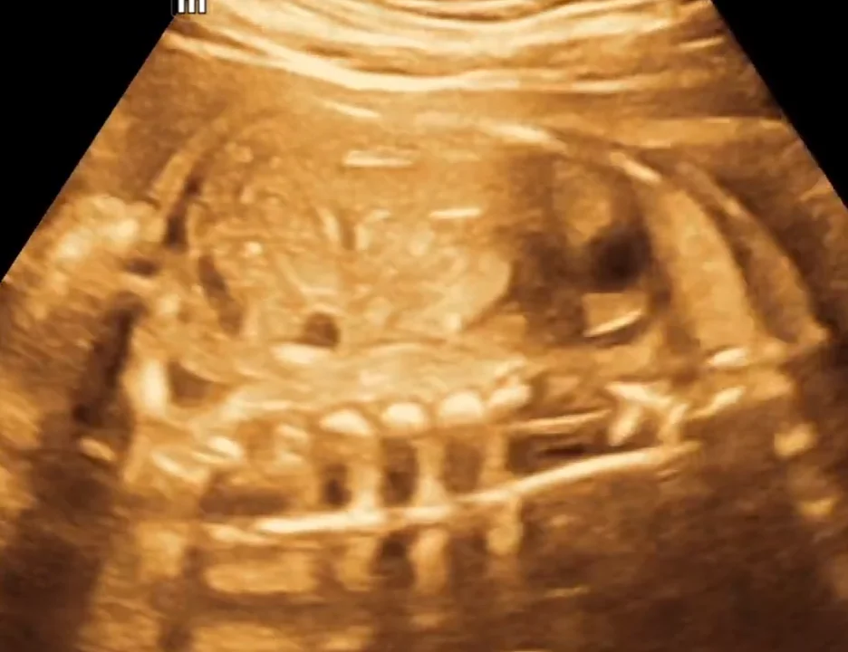 Nang lách thai nhi (Splenic Cyst)