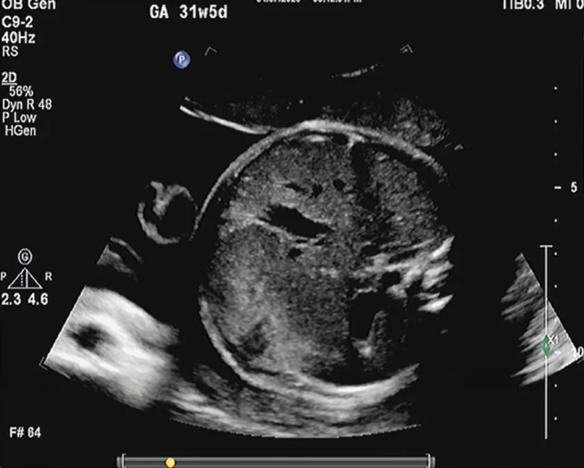 U máu gan bẩm sinh (Congenital Hepatic Hemangioma)