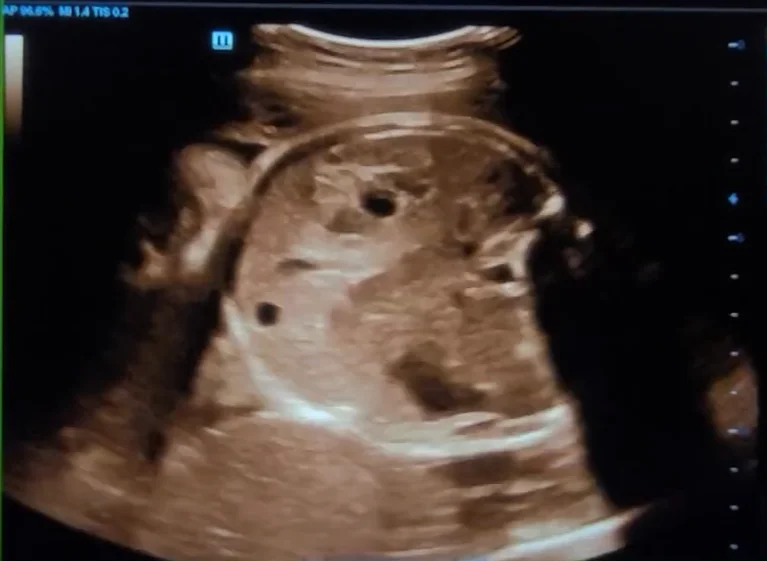 U mô thừa trung mô gan thai nhi (Mesenchymal Hamartoma)