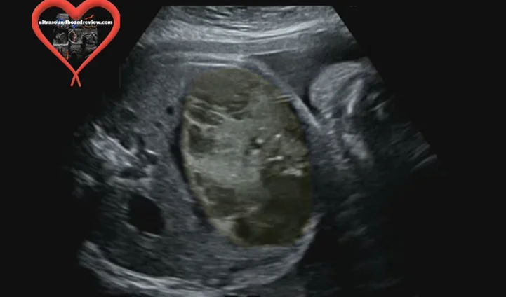 Ung thư nguyên bào gan thai nhi (Hepatoblastoma)