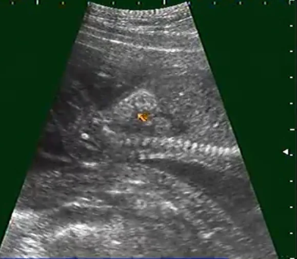 Ruột tăng âm thai nhi (Echogenic Bowel)