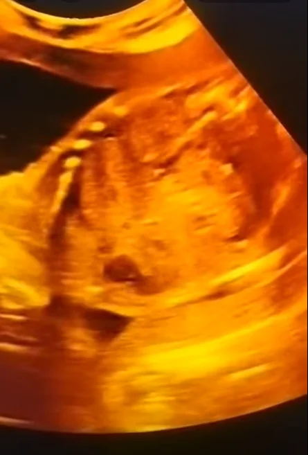 Báng bụng thai nhi (Ascites)