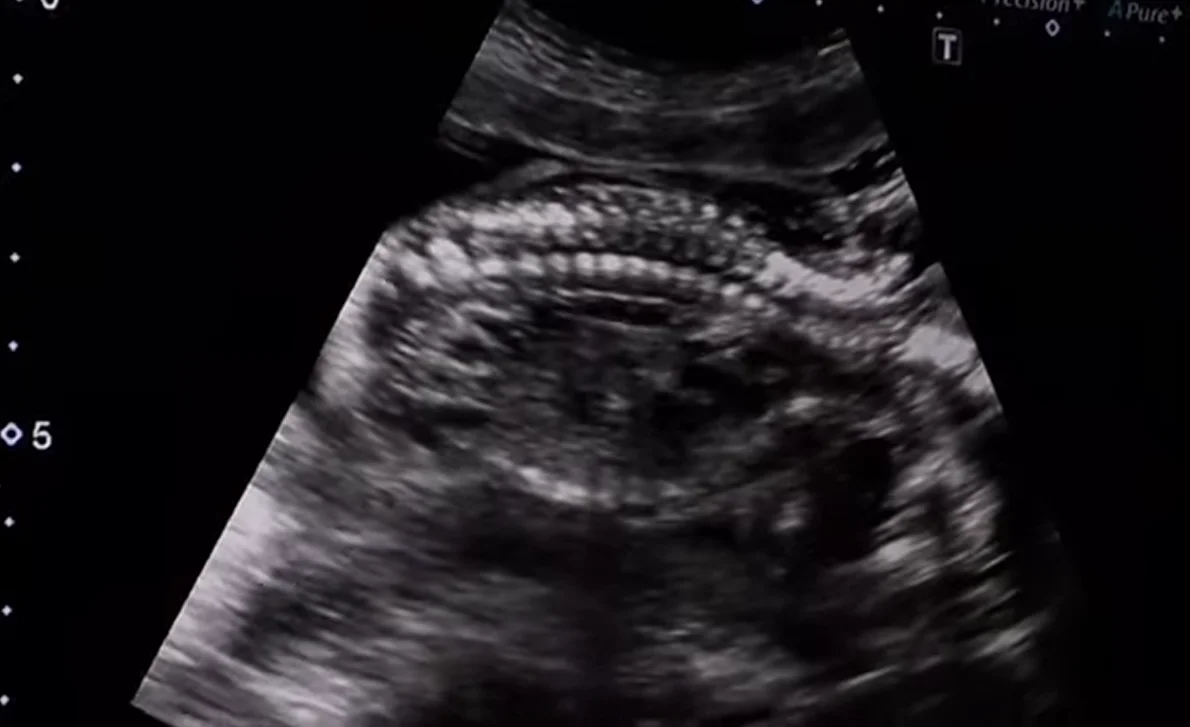 Nang ổ bụng thai nhi (Cystic Abdominal Mass)