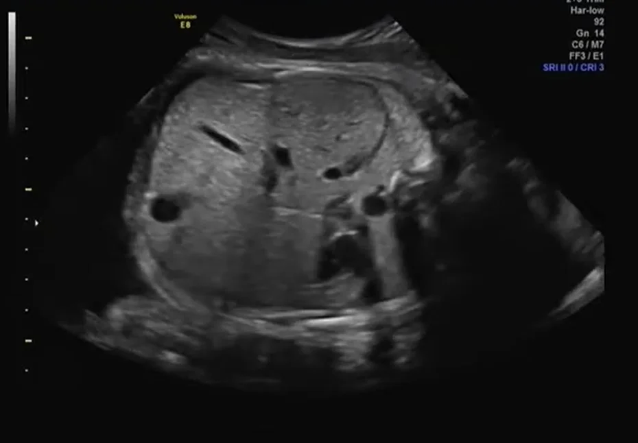 Gan to thai nhi (Hepatomegaly)