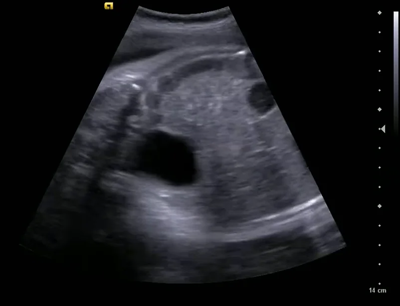 Bất sản thận một bên (Unilateral Renal Agenesis)