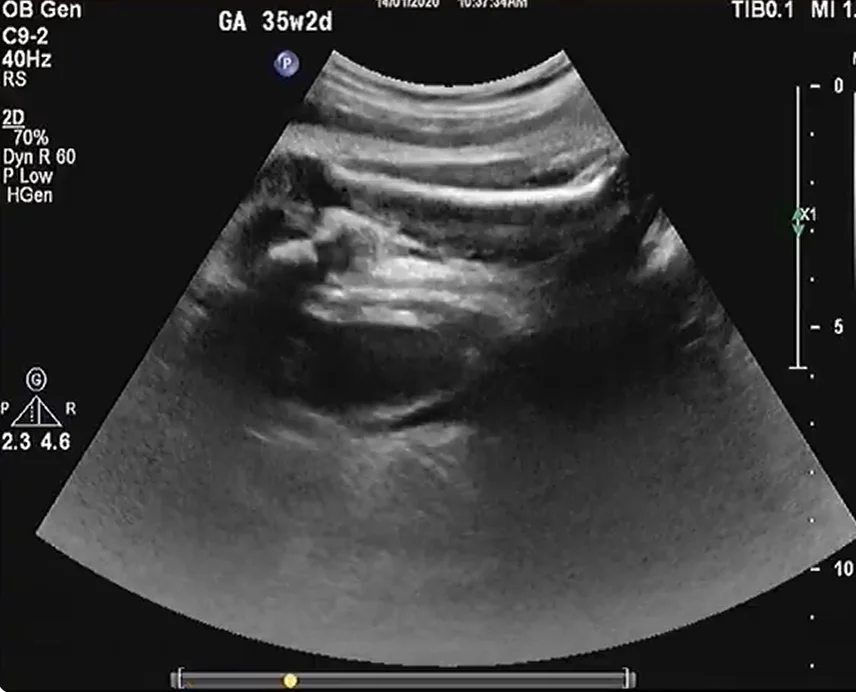 Thận đôi - niệu quản đôi (Duplicated Collecting System)