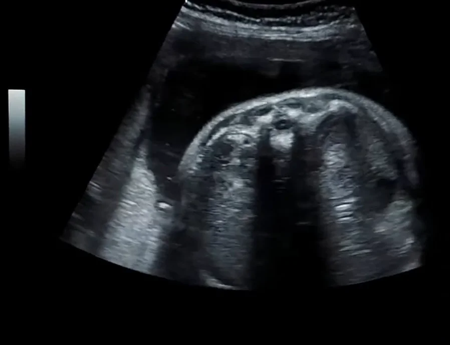 Thận lạc chỗ vùng chậu thai nhi (Pelvic Kidney)