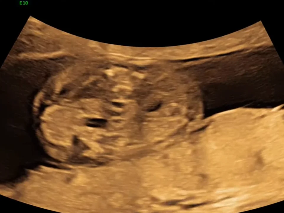 Thận móng ngựa thai nhi (Horseshoe Kidney)